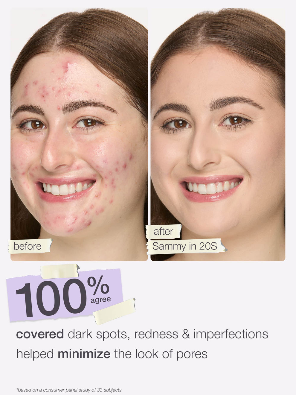 Before and after comparison of a woman's face with acne treatment, showing a clear improvement.