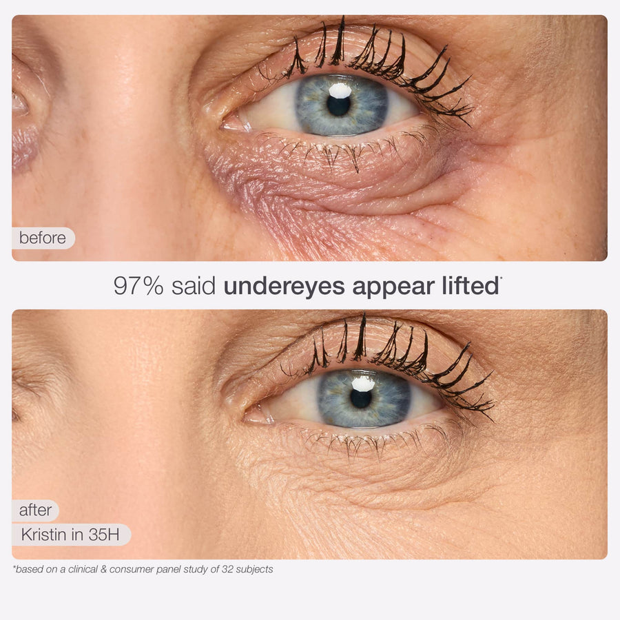 Before and after under eye lifted result