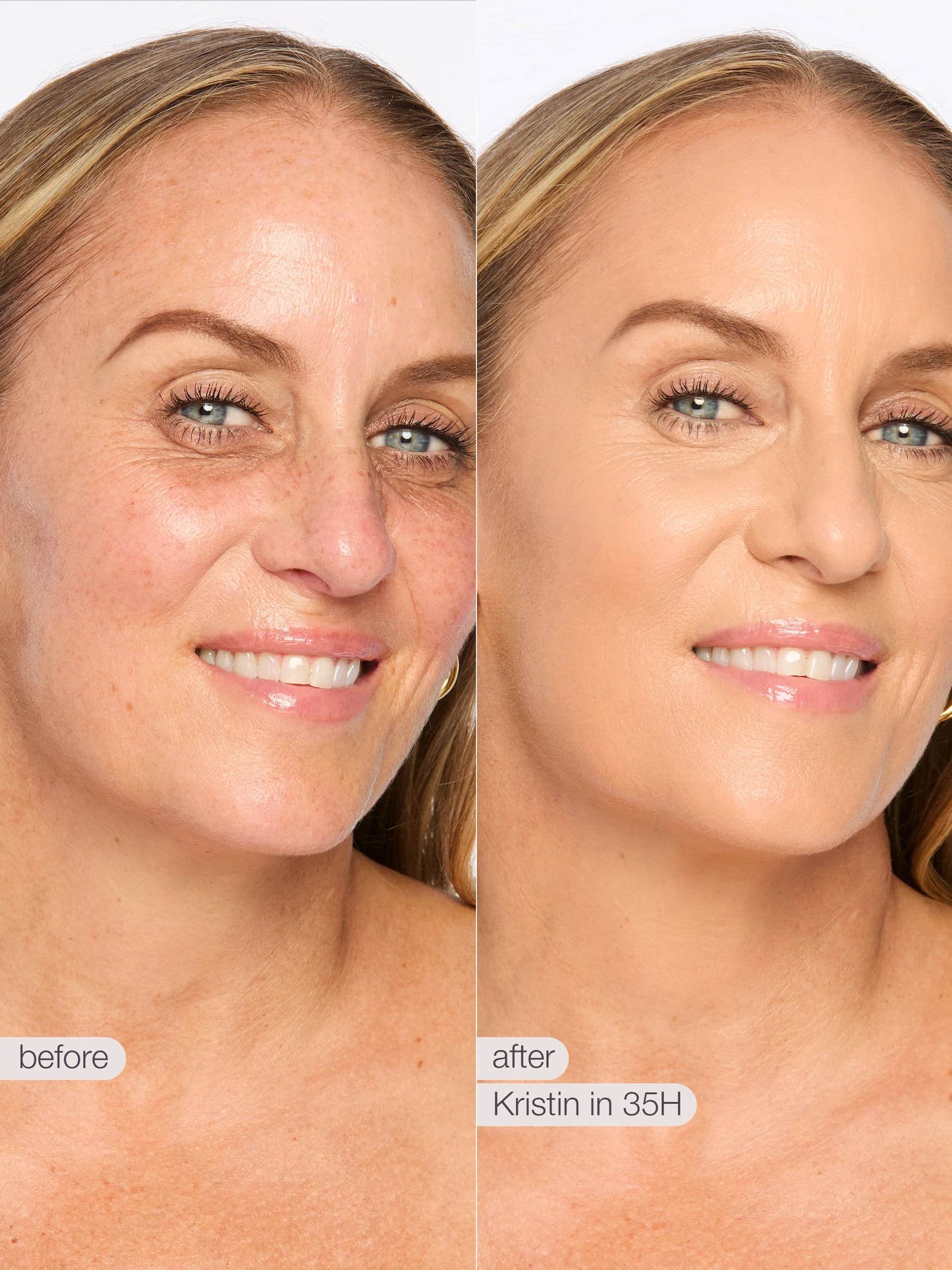 Before and after comparison of a woman's face with visible skin improvement, labeled 'Kristin in 35H'.