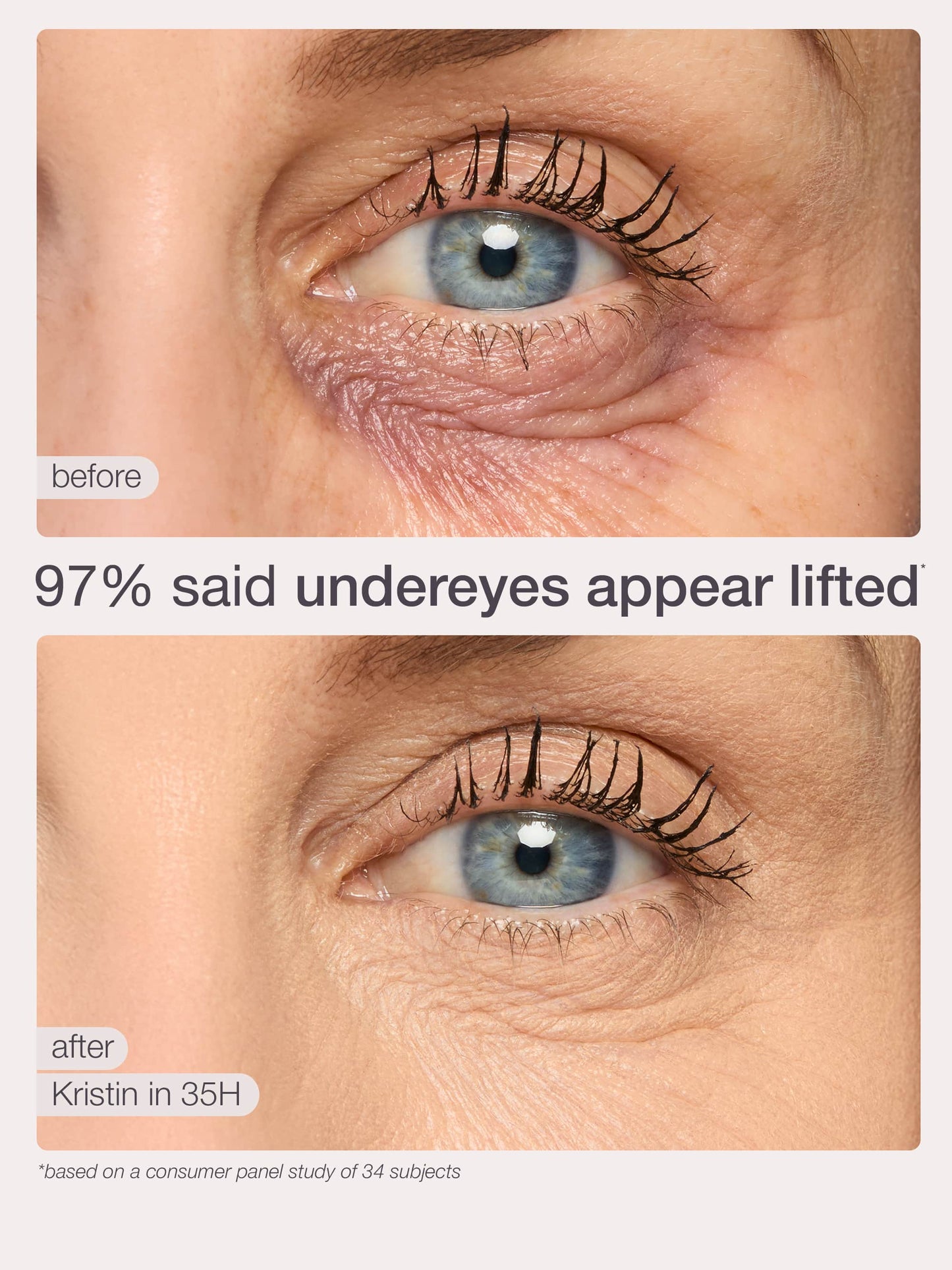 Before and after comparison of under-eye treatment showing lifted appearance.
